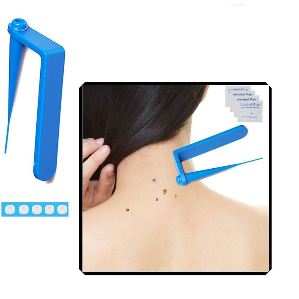 Skin Tag Removal Kit